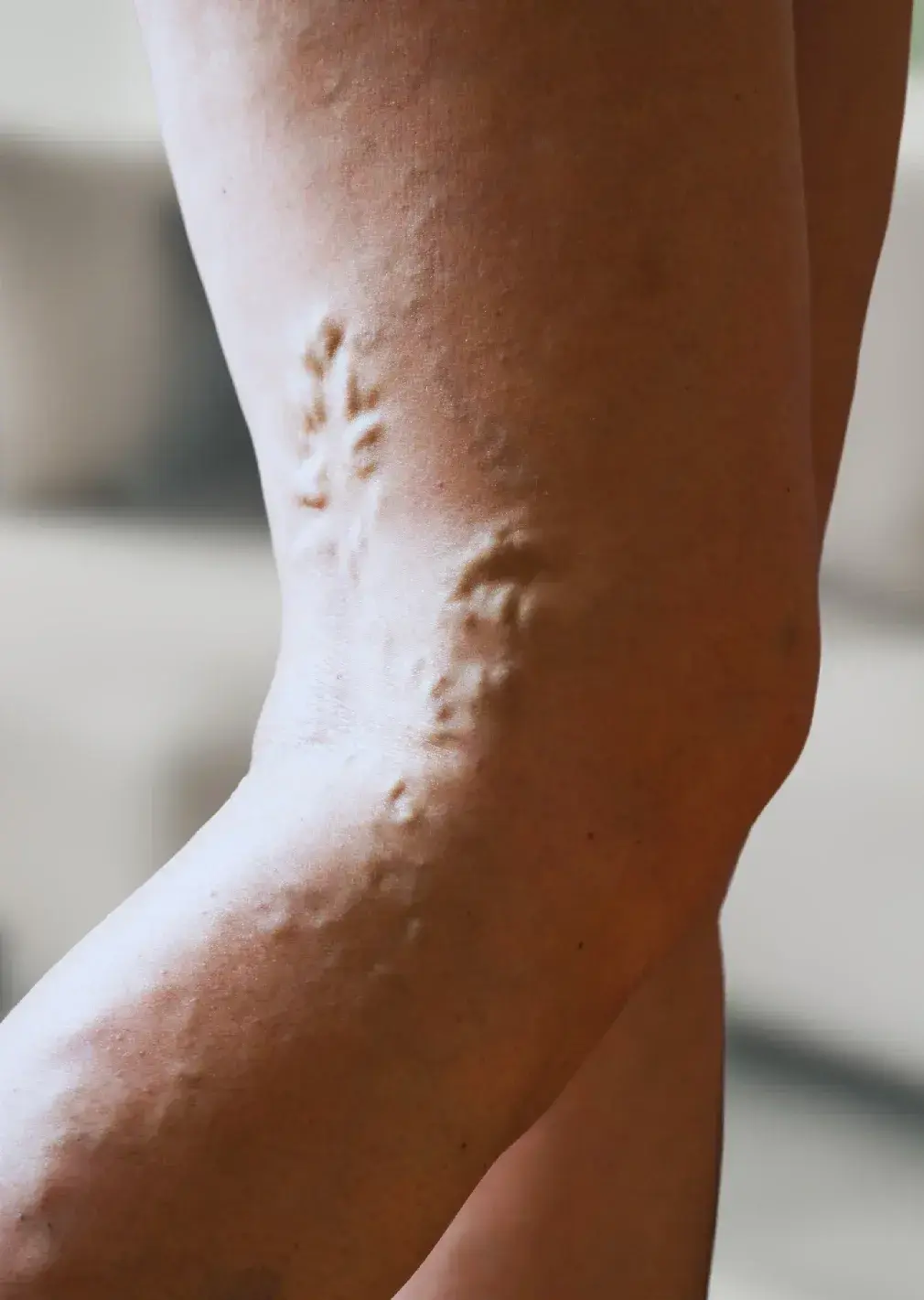 Thromboprophylaxis and DVT Care